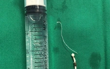 Lấy vòng tránh thai lạc chỗ suốt ¼ thế kỷ