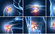 Thoái hóa khớp giai đoạn sớm: Nên bắt đầu bằng thuốc bôi tại chỗ và tập luyện