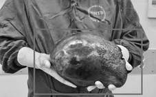 Cắt khối u gan khổng lồ nặng 2,5kg