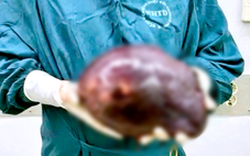 Cắt khối u gan khổng lồ nặng 2,5kg