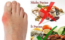 Đau do bệnh gút, các liệu pháp điều trị tự nhiên