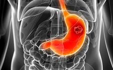 Bác sĩ chỉ cách ăn uống ngừa ung thư dạ dày