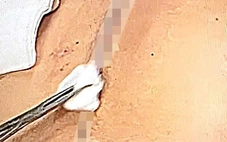 Chuyện kỳ lạ giữa lằn ranh sống - chết - Kỳ 9: 10 giờ chiến đấu với tử thần trên bàn mổ