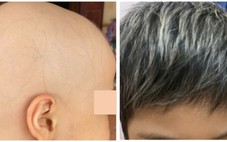 Bé gái 7 tuổi bị rụng hết tóc được điều trị thành công