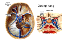 Ngạt mũi, đau đầu, thanh niên 25 tuổi nhập viện vì nhiễm trùng sọ