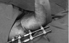 5 tiếng phẫu thuật nối lại cánh tay đứt rời cho người đàn ông