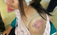 Bé gái bị bà nội, ông dượng và anh trai bà nội đánh đập dã man