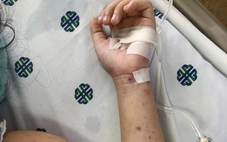 Bệnh não mô cầu tăng 6 lần, người khỏe mạnh có thể tử vong trong 24 giờ