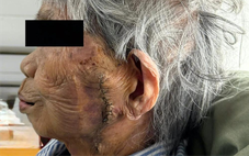 Phẫu thuật cắt bỏ khối ung thư lớn trên mặt cụ bà 99 tuổi