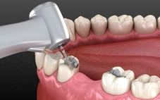 Nhiều nước kêu gọi cấm vật liệu trám răng chứa thủy ngân trước năm 2030