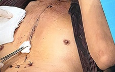 Chuyện kỳ lạ giữa lằn ranh sống - chết - Kỳ 9: 10 giờ chiến đấu với tử thần trên bàn mổ