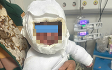 Bé 9 tháng tuổi bỏng 30% cơ thể vì kéo dây điện ấm siêu tốc