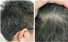 Có phải ‘tóc bạc nhiều là dấu hiệu của ung thư’?