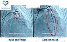 Bệnh viện Tâm Trí Cao Lãnh cứu sống 5 ca nhồi máu cơ tim cấp