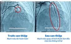 Bệnh viện Tâm Trí Cao Lãnh cứu sống 5 ca nhồi máu cơ tim cấp trong giờ vàng