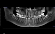 Bác sĩ hướng dẫn tránh sai lầm sau nhổ răng khôn - 'vị khách' đến muộn nhiều phiền toái