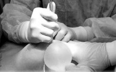 Cô gái bị biến dạng ‘vòng 1’ sau khi tiêm filler HA nâng ngực