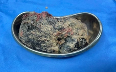 Lấy 0,5kg tóc trong dạ dày cháu bé 6 tuổi ở Quảng Ngãi