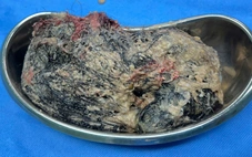 Lấy 0,5kg tóc trong dạ dày cháu bé 6 tuổi ở Quảng Ngãi