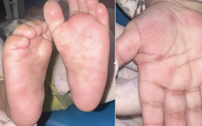 Trẻ 4 tháng tuổi mắc giang mai, ban đỏ nổi rải rác lòng bàn tay, chân