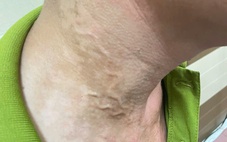 Lại phát hiện ca mắc giun rồng ở Phú Thọ