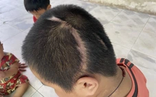 Vụ học sinh lớp 3 bị xe tông tổn thương 90%: Tòa án mời các bên liên quan làm việc lần hai