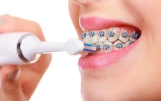 Ăn gì, vệ sinh răng thế nào khi đang niềng răng?