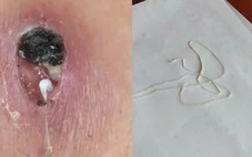 Phát hiện một ca mắc giun rồng, loại ký sinh trùng hiếm gặp dài hàng mét