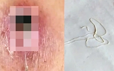 Phát hiện một ca mắc giun rồng, loại ký sinh trùng hiếm gặp dài hàng mét