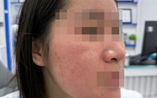 Hết trị bách bệnh, lại rước họa vì dùng nước cốt chanh trị mụn