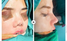 Mũi viêm - Biến chứng nguy hiểm cần nhận biết sớm và xử lý đúng cách
