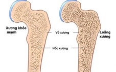 Làm gì để phòng ngừa bệnh loãng xương?
