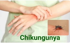 Bệnh Chikungunya đang diễn biến phức tạp, ai cần cẩn trọng?