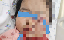 Bé gái 2 tuổi bị dập phổi, rách mặt do vặn tay ga xe máy vừa dừng trước cửa nhà