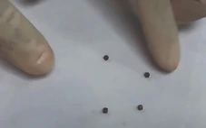 Bé trai nuốt 4 cục nam châm dính chặt vào nhau gây thủng ruột