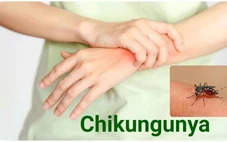 Bộ Y tế bác thông tin Việt Nam phát hiện ca mắc Chikungunya