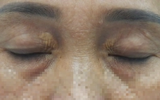 Mí mắt nổi mảng màu vàng, coi chừng rối loạn lipid máu