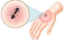 Thực hư chuyện dùng kiến để xua đuổi muỗi truyền bệnh chikungunya