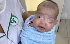 Trẻ sơ sinh 8 ngày tuổi bị uốn ván nặng
