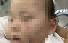 Công an tạm giữ cô giáo để điều tra vụ bé gái có vết bầm trên mặt sau khi đi học
