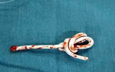 Bé trai cấp cứu do nhét dây vào lỗ tiểu, theo clip 'thử thách' trên mạng