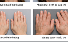 Bỗng dưng bàn tay, bàn chân to ra: Có thể là dấu hiệu bệnh lý nguy hiểm