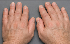 Bỗng dưng bàn tay, bàn chân to ra: Có thể là dấu hiệu bệnh lý nguy hiểm