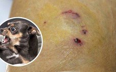 Bốn người trong gia đình bị chó cắn nhưng không tiêm phòng, một người tử vong