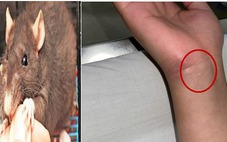 Cảnh báo bệnh lý nguy hiểm khi bị chuột cắn