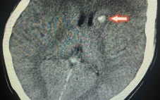 Mông, đùi chảy mủ sau khi tiêm chất làm đầy