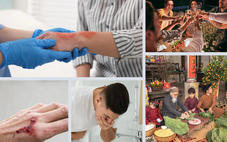 Cách xử trí những tình huống thường gặp ngày Tết, chuyên gia khuyến cáo tránh xa 'mẹo'