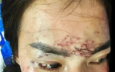 Sẽ xử tội cố ý gây thương tích và giữ người trái pháp luật trong vụ xăm lên mặt tình địch