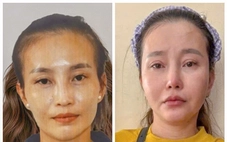 Phẫu thuật thẩm mỹ để trốn truy nã nhưng vẫn bị bắt