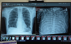 Kỳ tích y khoa: Sống sót 48 giờ không cần phổi